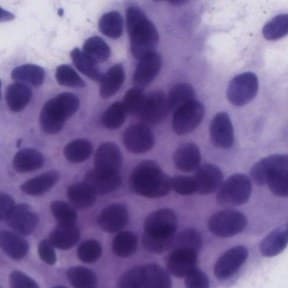 A cluster of benign breast cells, Papanicolaou stain