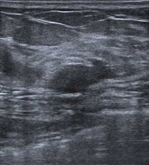 A breast ultrasound frame of a fibroadenoma with a dashed outline where the radiologist marked the mass