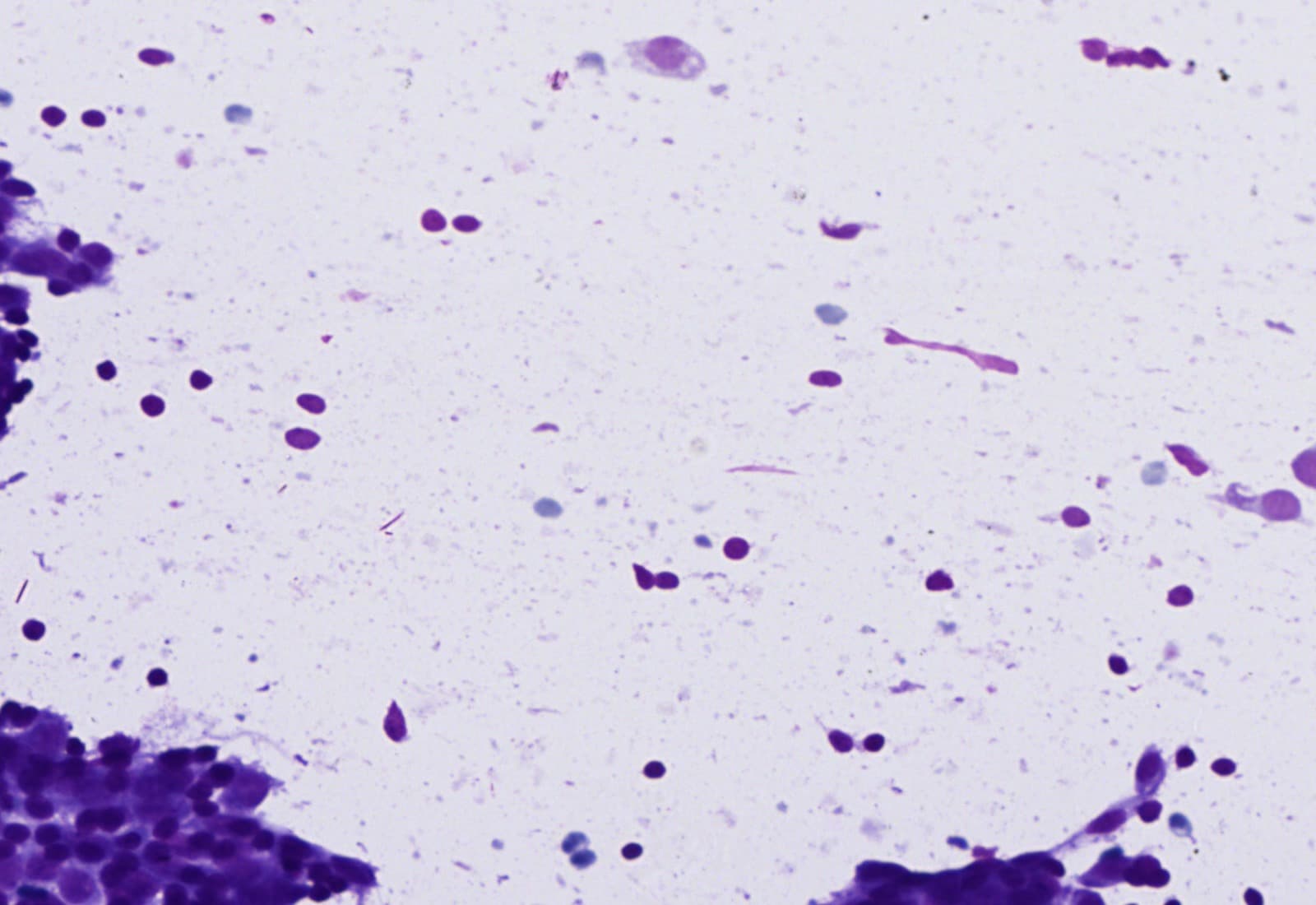 Benign, scattered cells, MGG