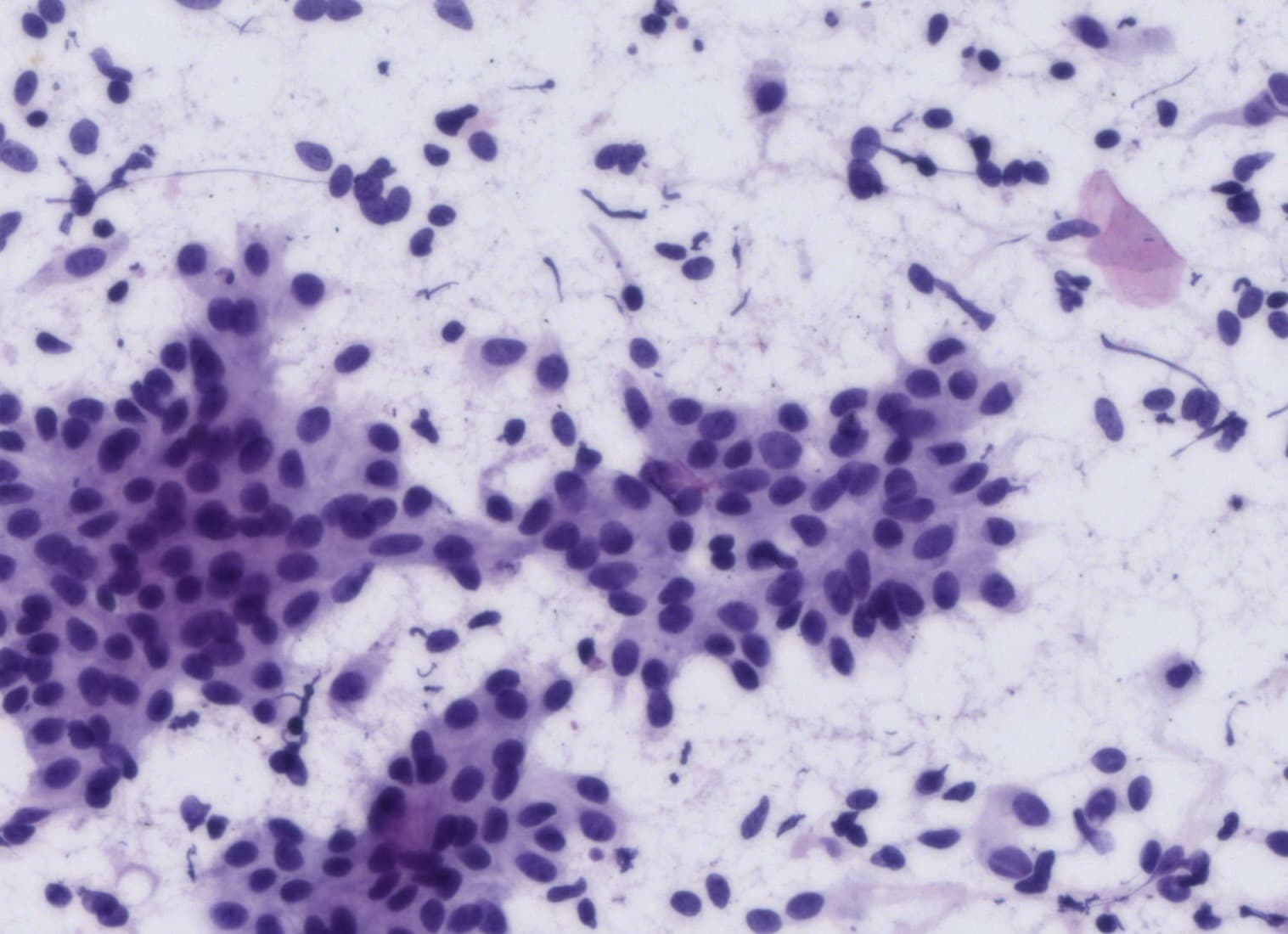 Benign clusters, Pap
