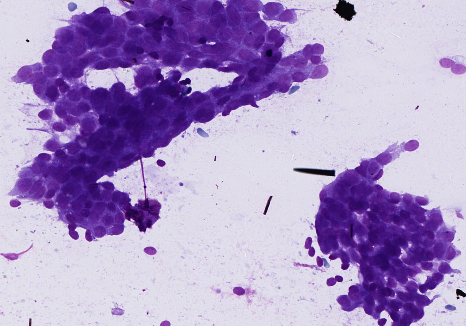 Atypical clusters, MGG