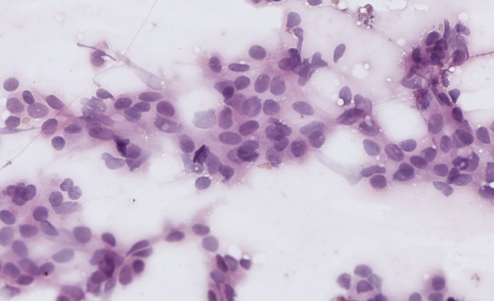 Atypical, scattered, Pap