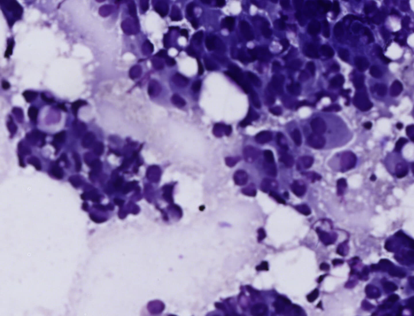 Malignant in fat, MGG