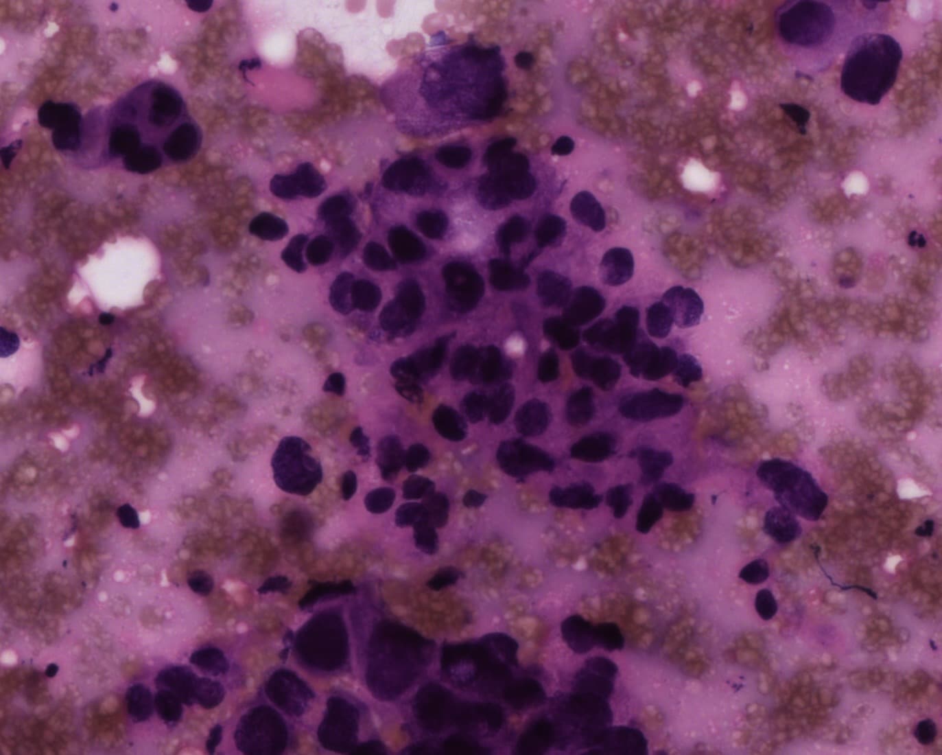 Malignant, dark nuclei, Pap
